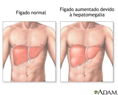 Hepatomegalia