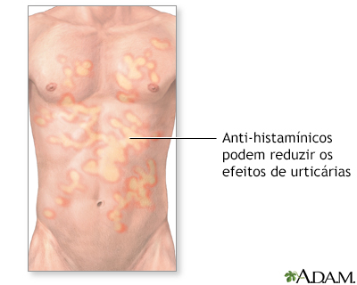 Tratamento da urticária