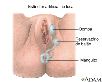 Esfíncter artificial inflável