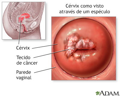 Exame de Papanicolau e câncer cervical