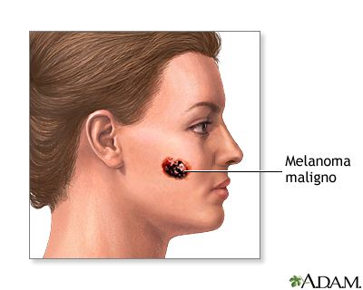 Melanoma maligno