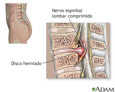 Hérnia de disco na região lombar