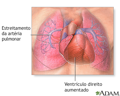 Hipertensão pulmonar primária