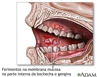 Úlceras orais