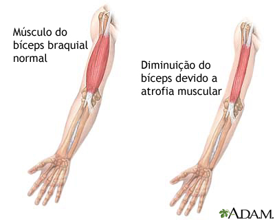 Atrofia muscular