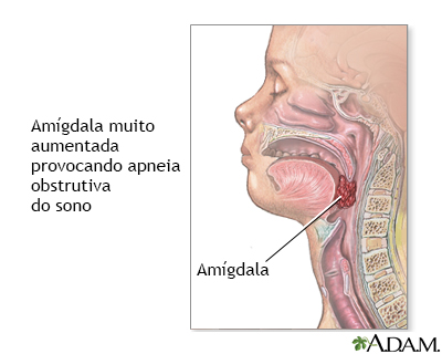 Apneia obstrutiva do sono