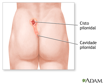 Depressão e cisto pilonidal