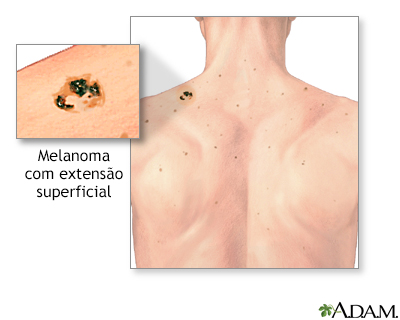 Melanoma