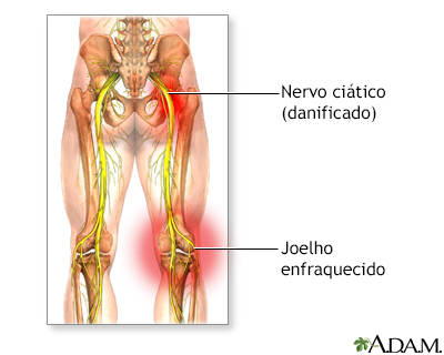 Danos ao nervo ciático