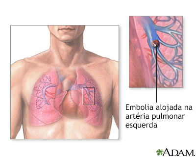 Embolia pulmonar