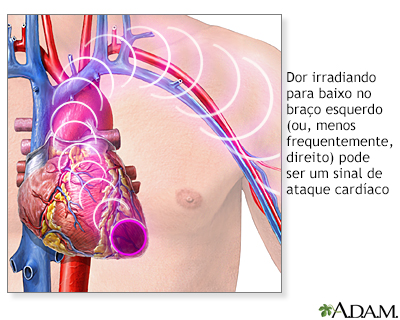 Sintomas de ataque cardíaco