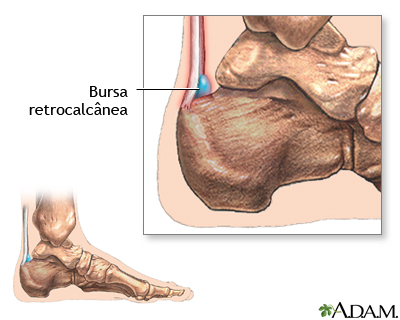 Bursite retrocalcânea