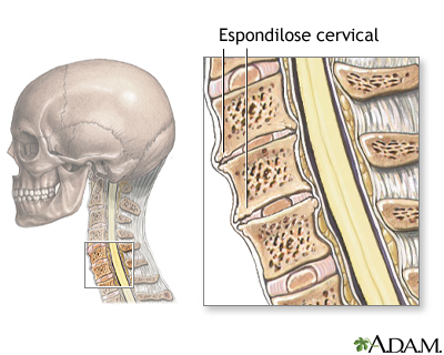 Espondilose cervical