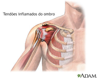 Tendões inflamados do ombro