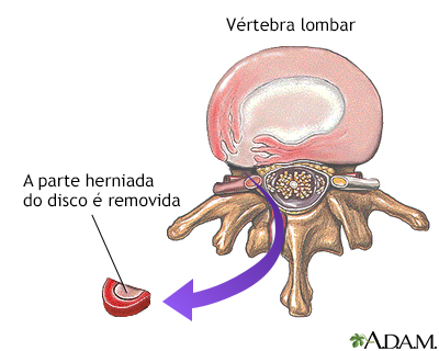 Reparação de hérnia de disco