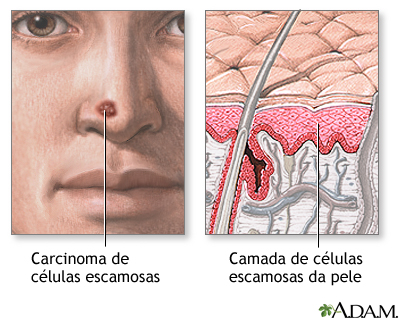 Câncer de célula escamosa