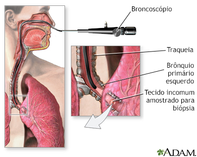 Broncoscópio