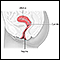 Cervical dysplasia - series