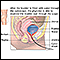 Cystoscopy