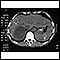 Tumor suprarenal - TC