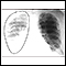 Rompimento da aorta, radiografia do tórax