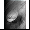 Gallstones, cholangiogram