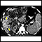 Cáncer hepatocelular - TC