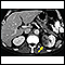 Kidney tumor - CT scan