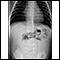 Radiografía de una invaginación