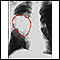 Lung cancer - frontal chest X-ray