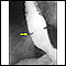 Radiografía del anillo de Schatzki