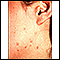 Warts - flat on the cheek and neck