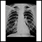 Pulmones de un trabajador del carbon -  radiografía de tórax