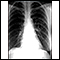 Coccidioidomicosis - radiografía de tórax