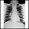 Sarcoidosis, estado I - radiografía de tórax