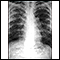 Sarcoidosis, estado II - radiografía de tórax