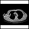 Masa pulmonar, pulmón derecho - Tomografía