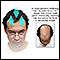 Male pattern baldness