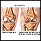 Osteoartritis