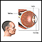 Retinitis por CMV