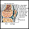 Artrite reumatoide