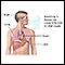 Coccidioidomicosis diseminada