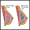 Fibrocystic breast disease