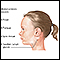 Mononucleosis infecciosa