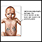 Neonatal adrenoleukodystrophy