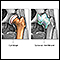 Osteoartritis contra artritis reumatoide