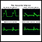 Traçado de ondas de ECG pós-infarto do miocárdio