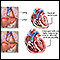 Cardiomiopatía alcohólica