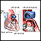 Left atrial myxoma