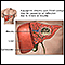 Pyogenic abscess